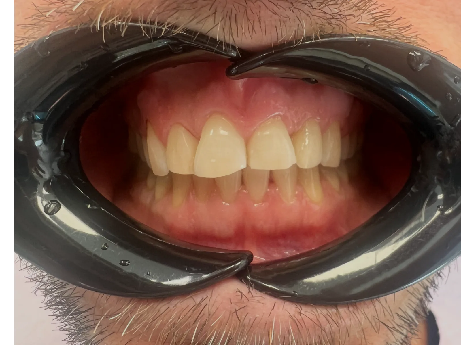 Smilezor láthatatlan fogszabályozás utáni eredmény