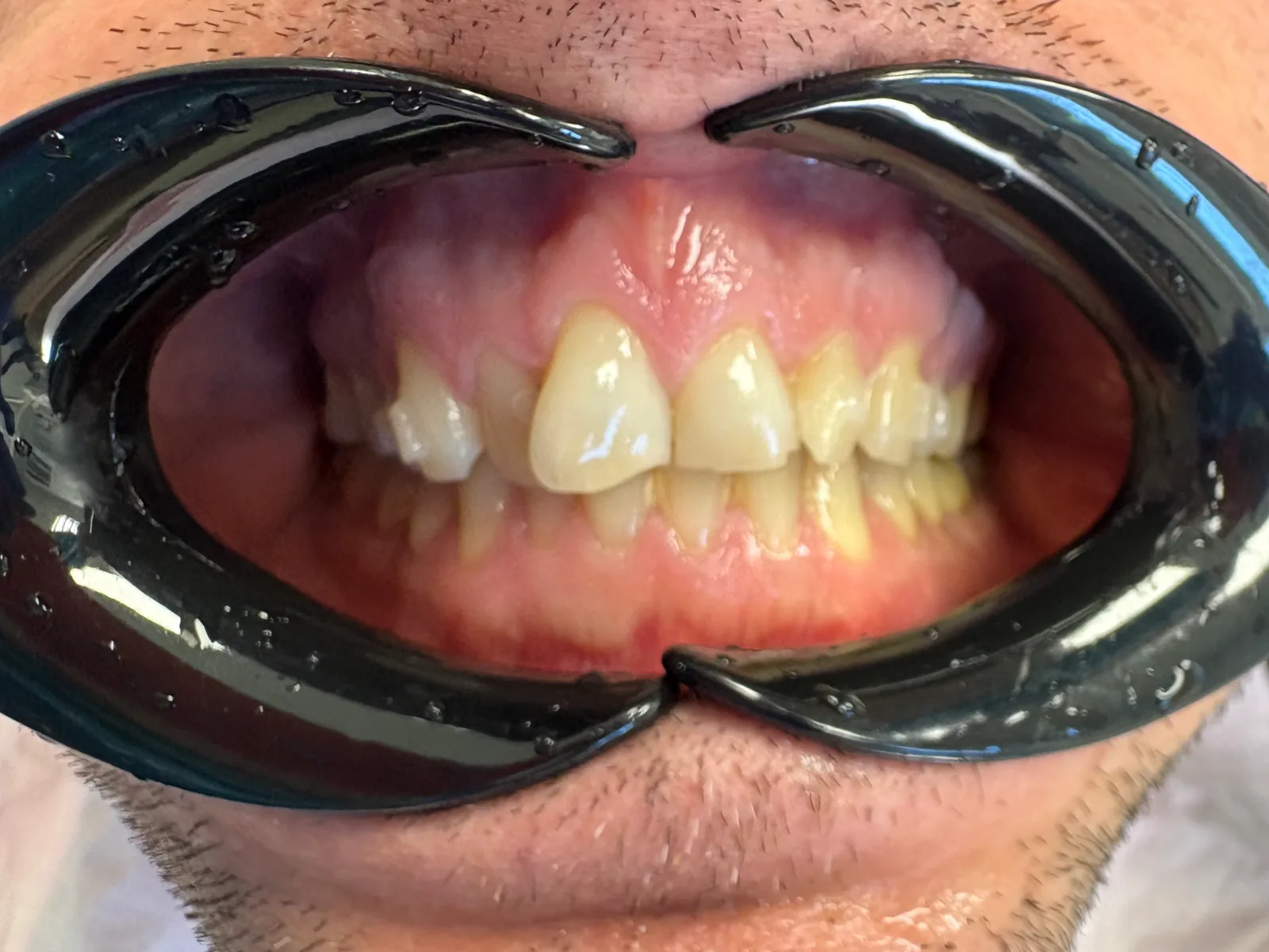 Smilezor láthatatlan fogszabályozás előtti állapot