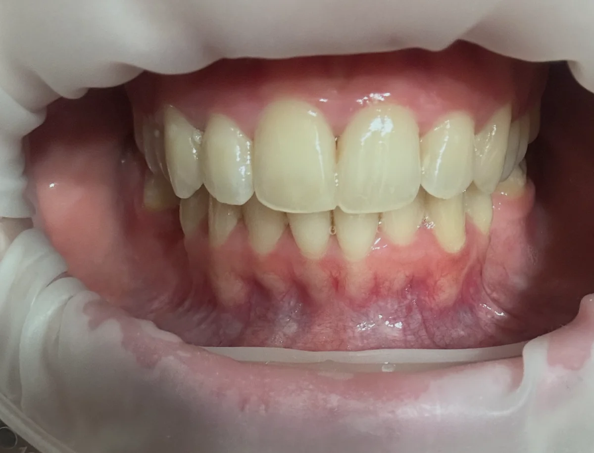 Smilezor láthatatlan fogszabályozás utáni eredmény