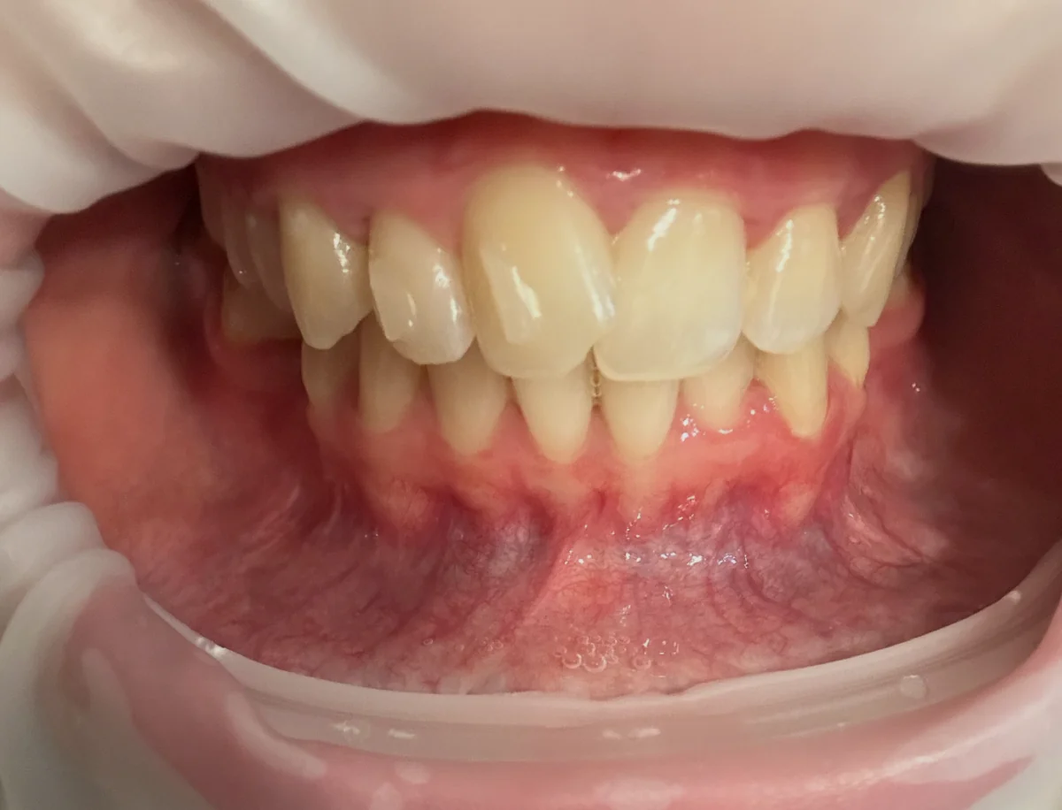 Smilezor láthatatlan fogszabályozás előtti állapot